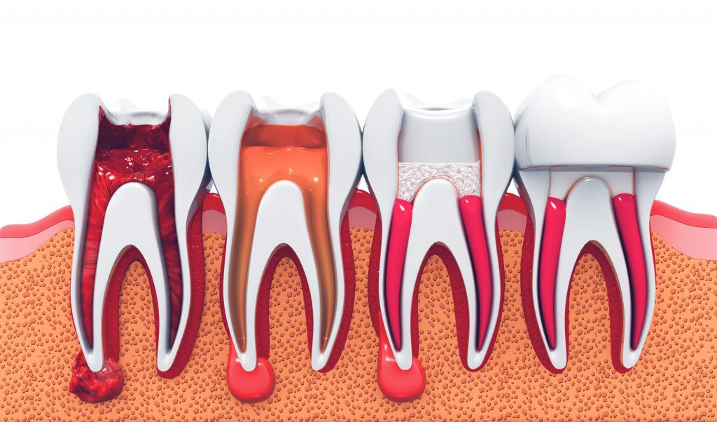 stages of root canal treatment